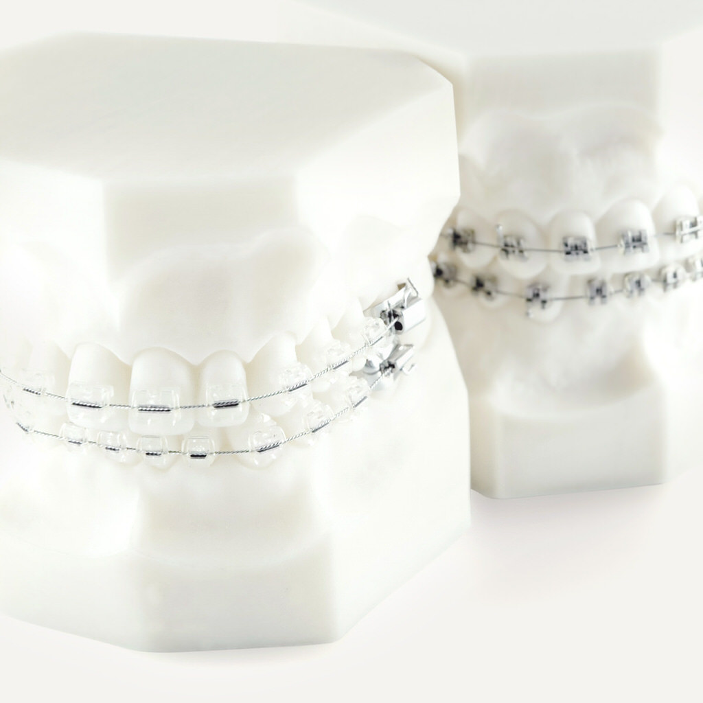 Feste Zahnspangen - Brackets